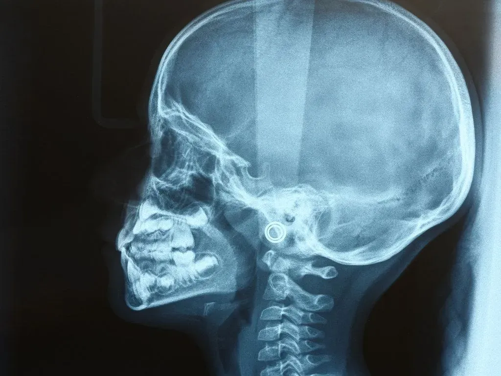 A baby head x-ray is a useful diagnostic tool.