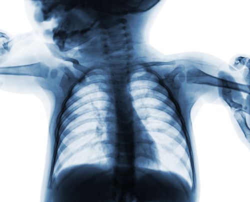 A baby chest xray is a low risk test.